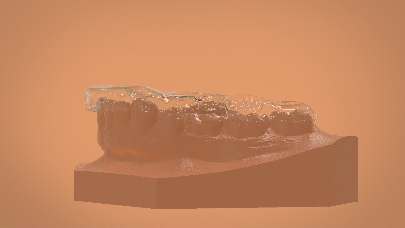 STL file Digital Mandibular Tanner Splint 🦷・3D printer model to ...