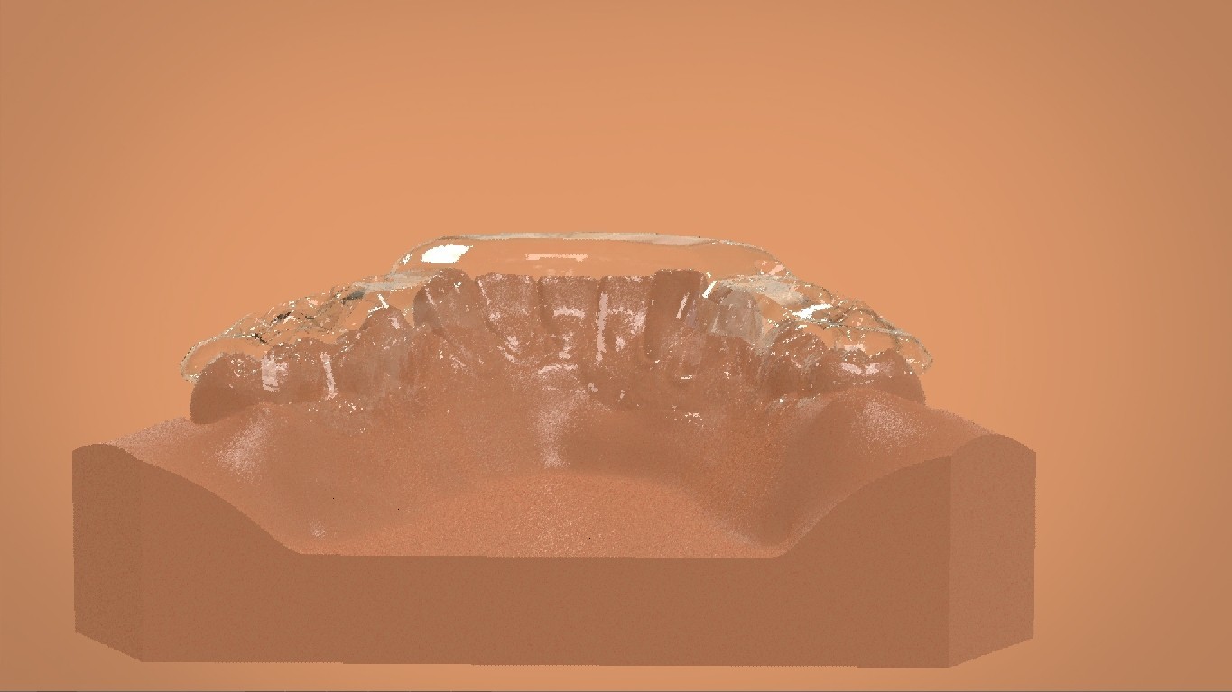 STL file Digital Mandibular Tanner Splint 🦷・3D printer model to ...