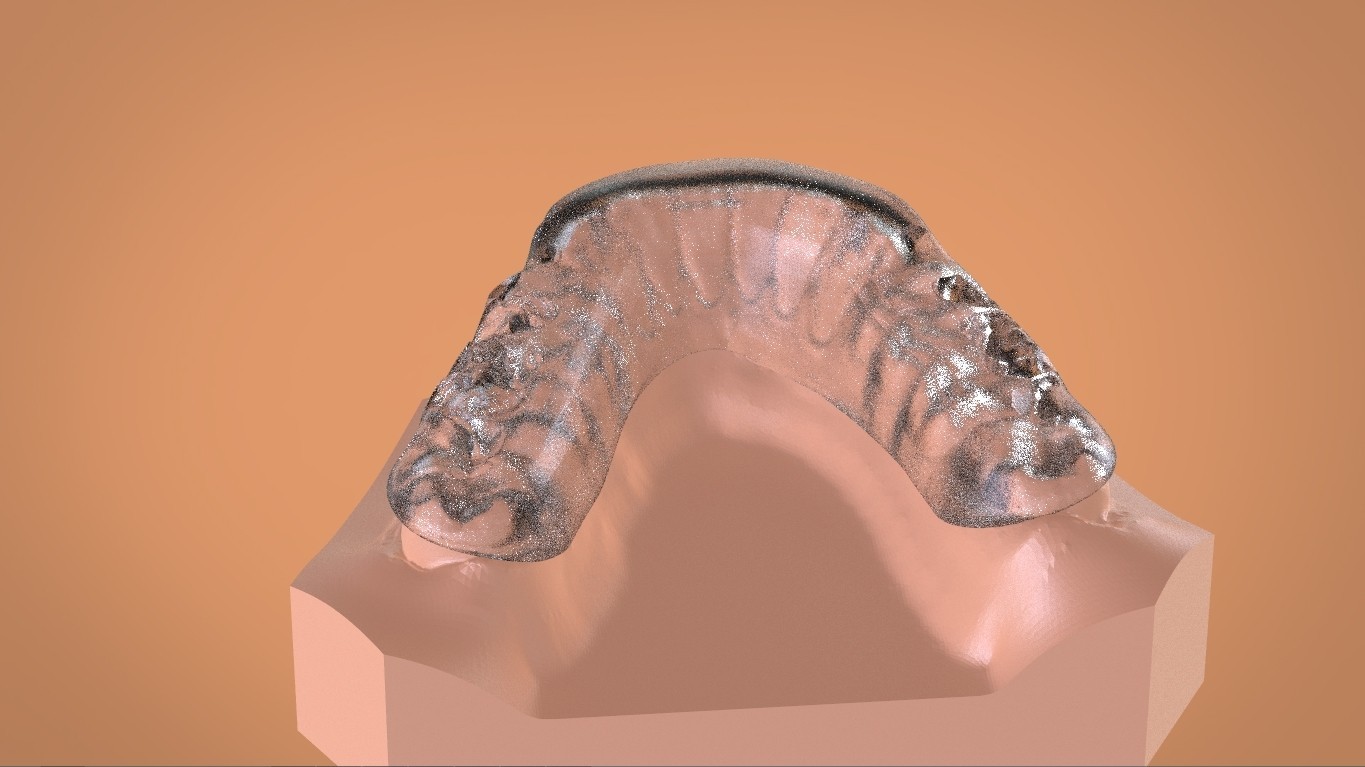STL file Digital Mandibular Tanner Splint 🦷・3D printer model to ...