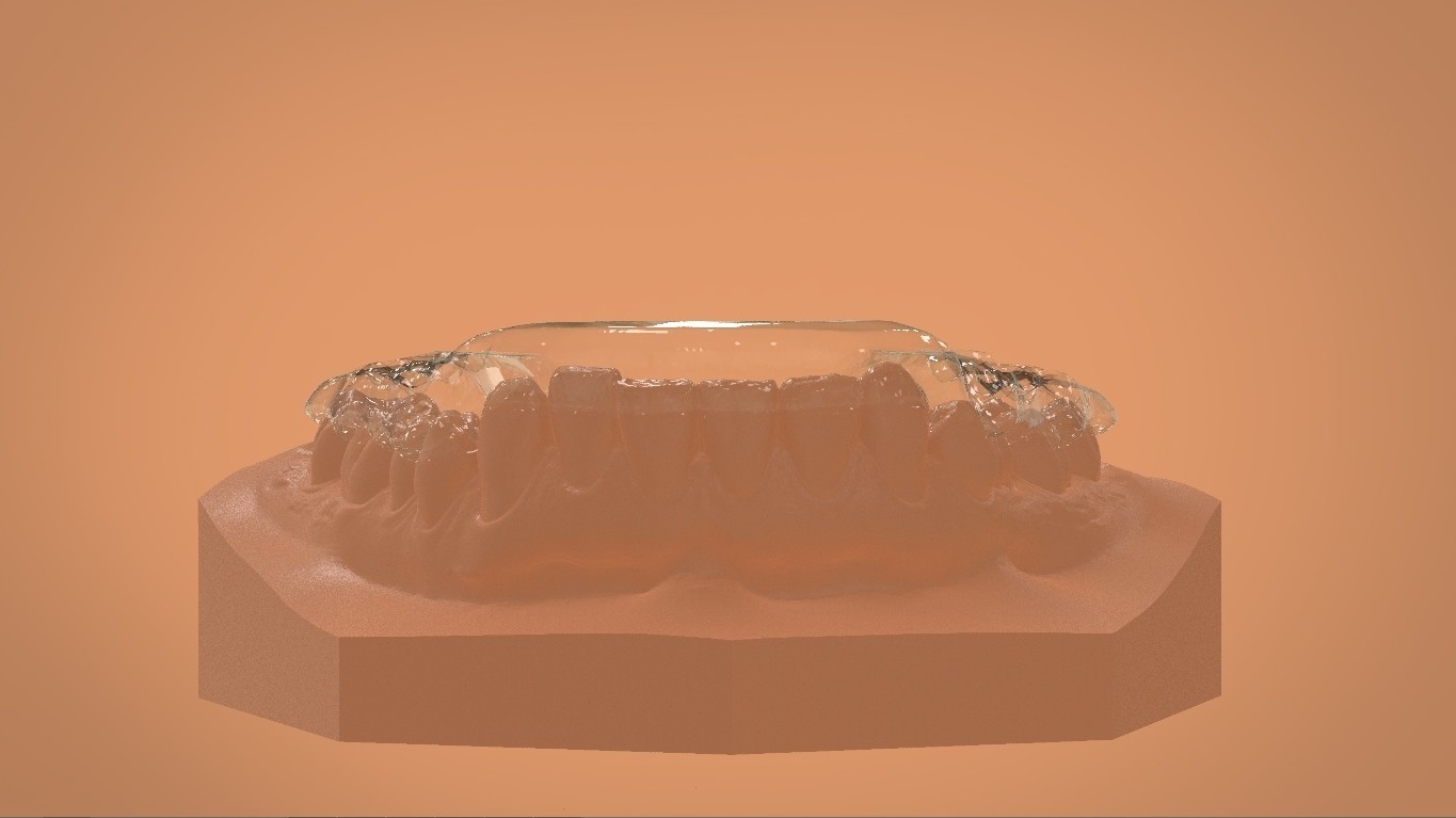 STL file Digital Mandibular Tanner Splint 🦷・3D printer model to ...