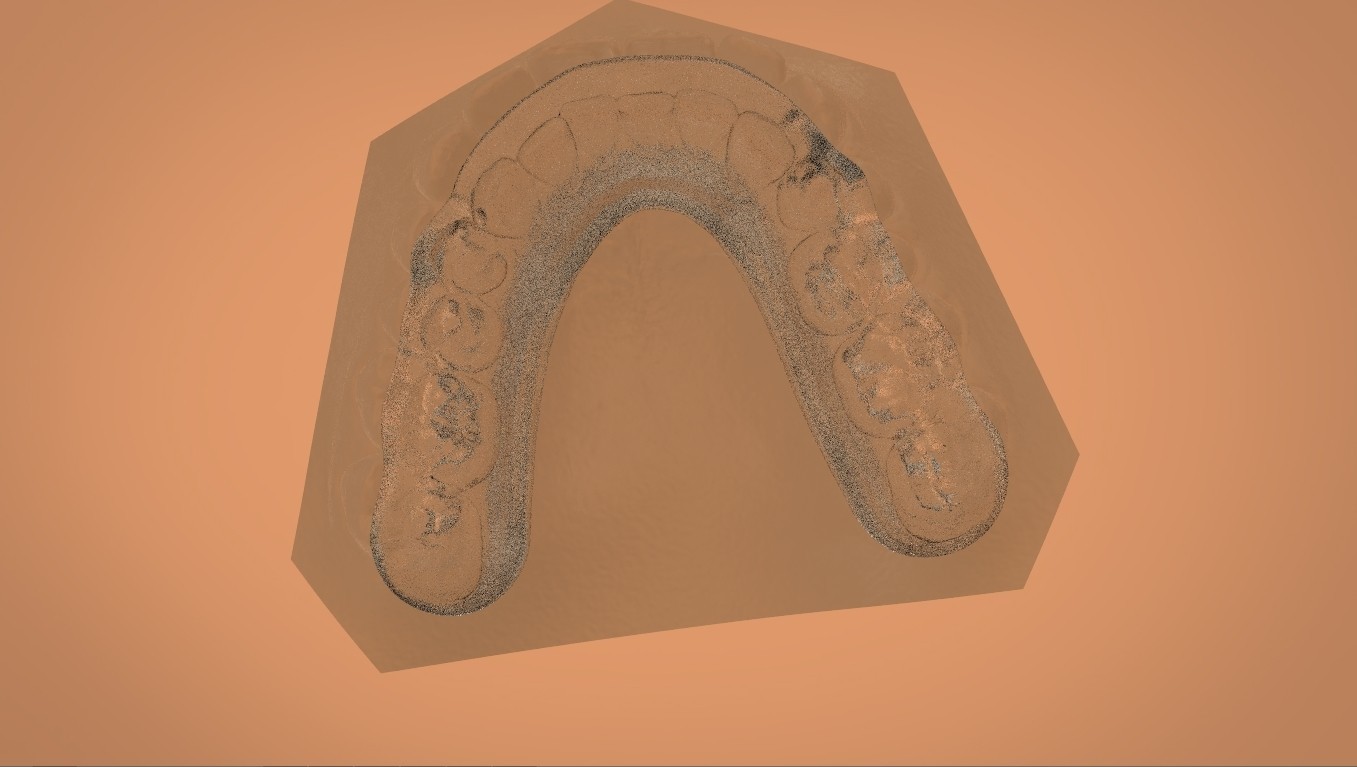 STL file Digital Mandibular Tanner Splint 🦷・3D printer model to ...