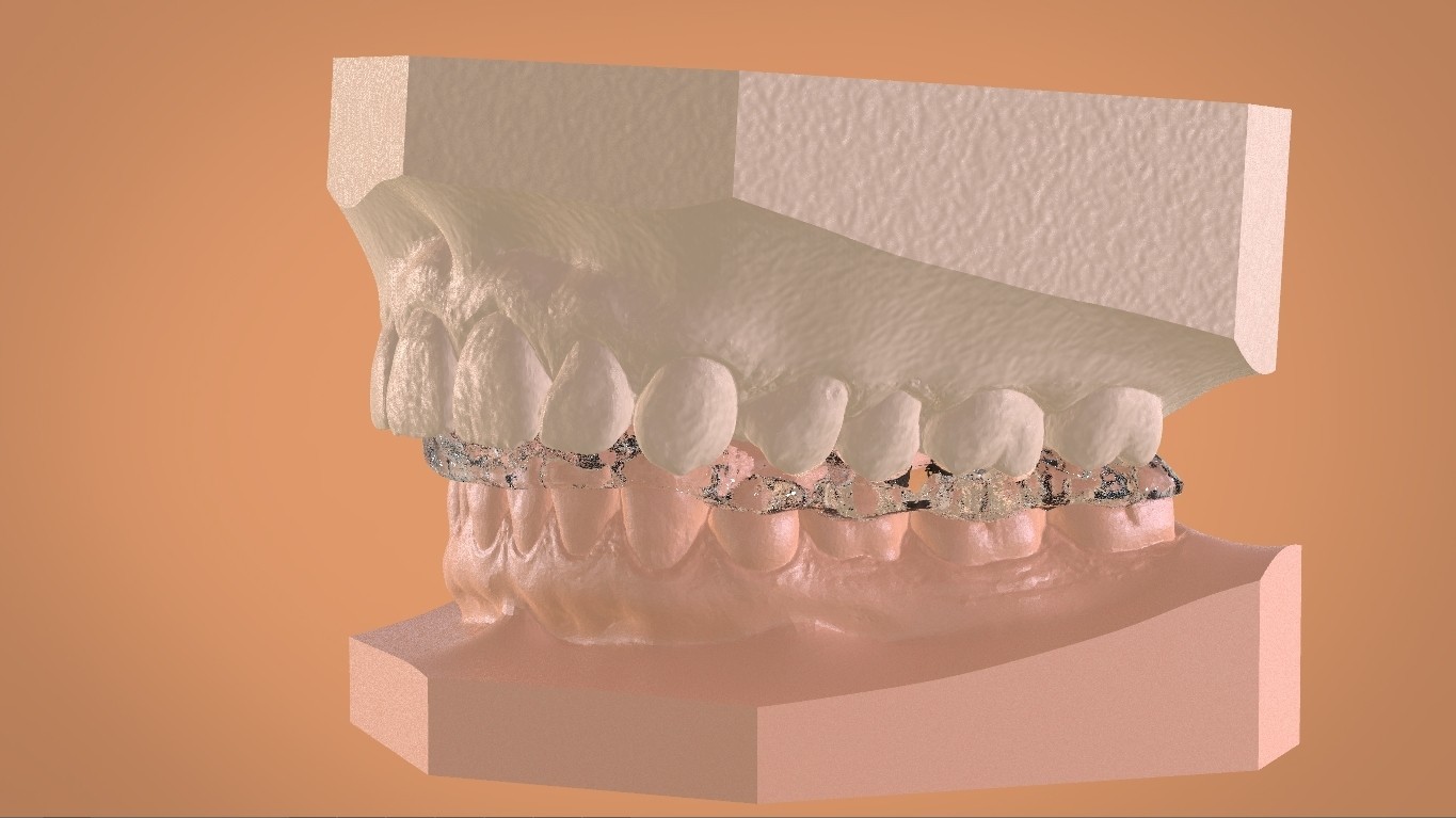 STL file Digital Mandibular Tanner Splint 🦷・3D printer model to ...