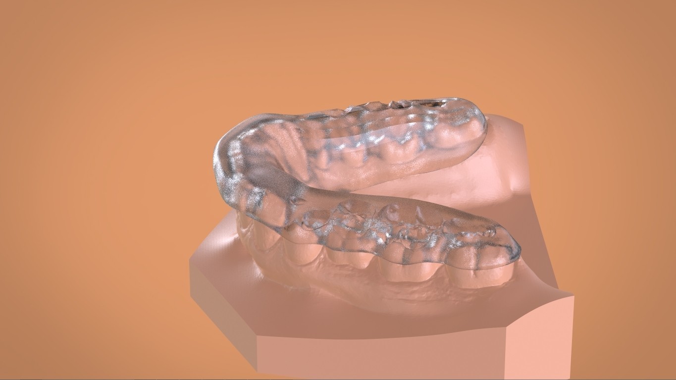 STL file Digital Mandibular Tanner Splint 🦷・3D printer model to ...