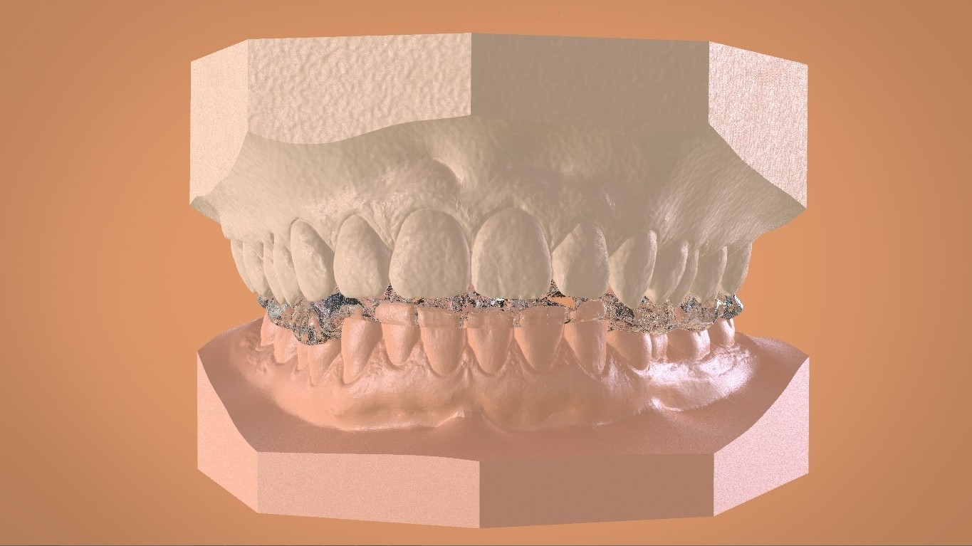 STL file Digital Mandibular Tanner Splint 🦷・3D printer model to ...